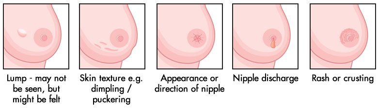 Lump on breast the nipple