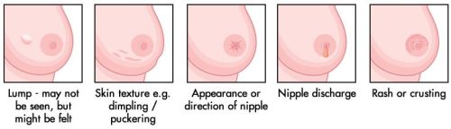 mimosa-child:severingsnapes:  This is for EVERYONE BY THE WAY. No matter your biological sex, you can still get breast cancer because we all have breast tissue.  LITERALLY REBLOG TO SAVE A LIFE