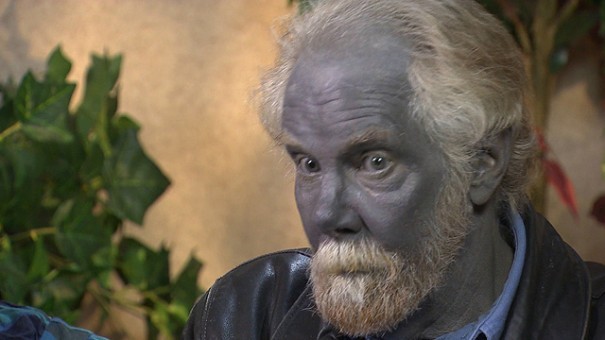 drankinwatahmelin:  sixpenceee:  A condition caused by the ingestion of silver, the