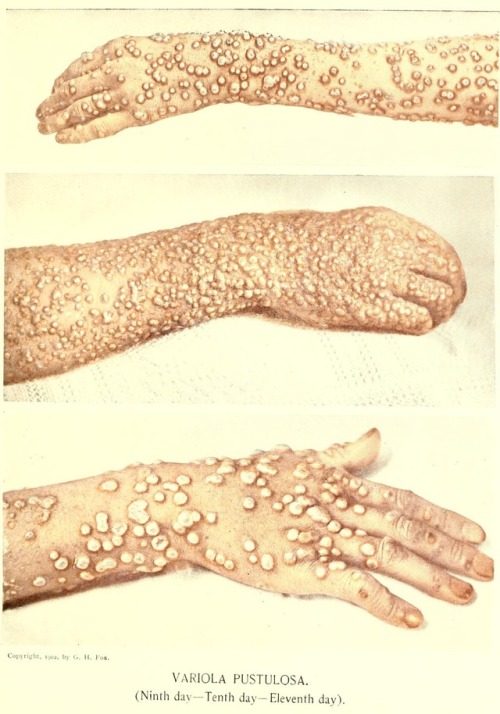 “These illustrations show the pustular lesions in the stages of complete distention when they presen