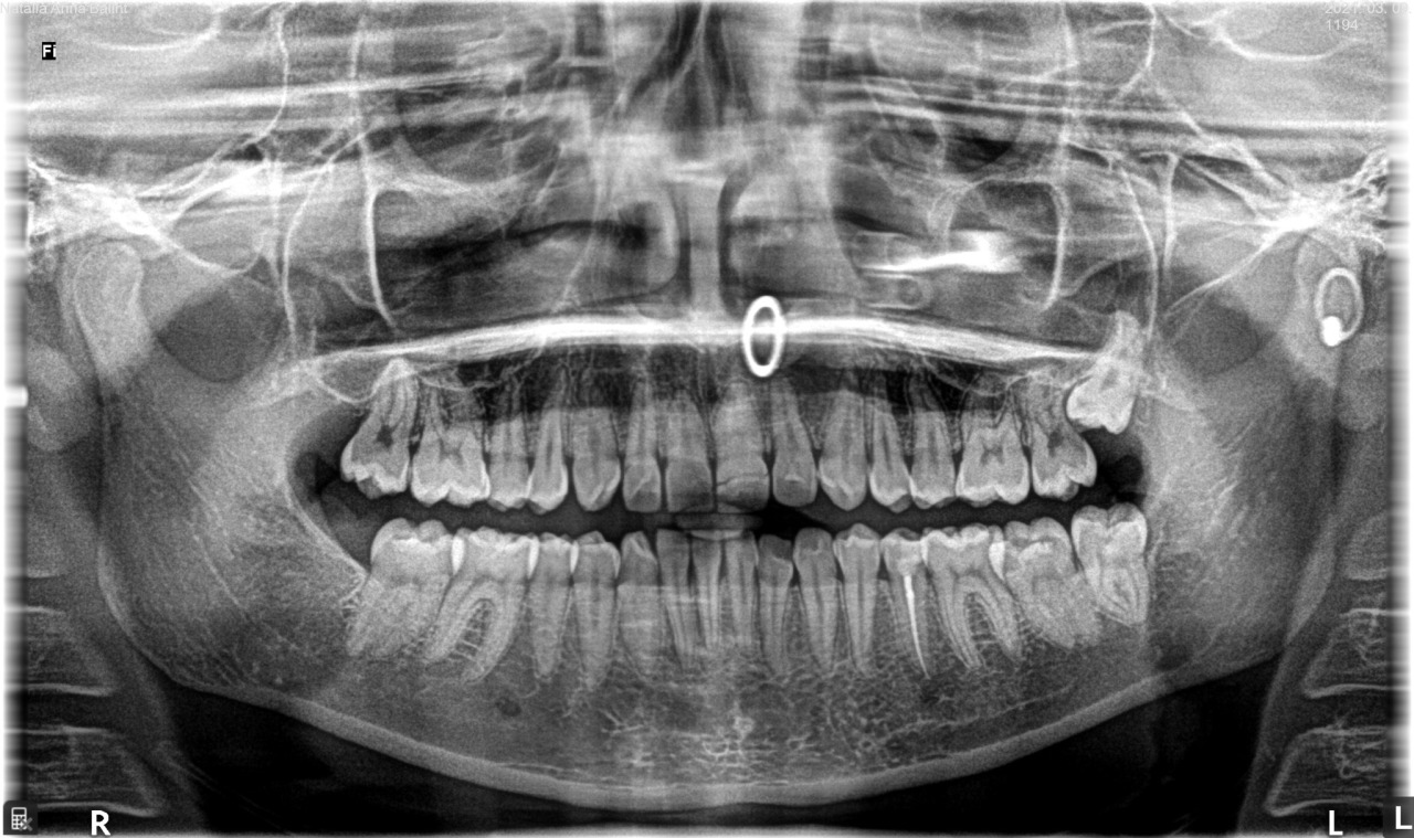 paintdeath:xrays from before i got my last two wisdom teeth removed (today)