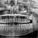 paintdeath:xrays from before i got my last two wisdom teeth removed (today)