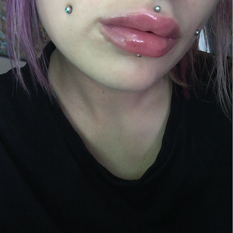 creepitreal666:  They’re swollen right now (obviously bc I just had them done)