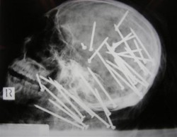 psychxpathis:X-ray of a man killed with a
