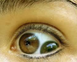 sixpenceee:  Pupula Duplex is said to be a rare condition in which a person has two irises and two pupils in one eye. This condition does not officially exist in official medical literature. Since there isn’t a great deal of evidence in the form of