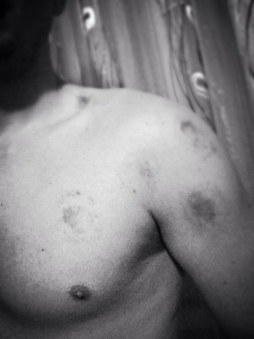 On love chest bite love bite On love chest bite love bite