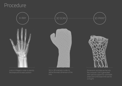 diloolie:  futuretechreport:  Cortex: The 3D-Printed Cast After many centuries of splints and cumbersome plaster casts that have been the itchy and smelly bane of millions of children, adults and the aged alike the world over, we at last bring fracture