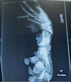 sixpenceee:  This is an X-Ray of an arm after a meat grinder accident. OUCH.