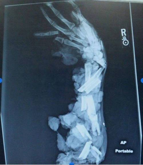 deadweight-at7am:gplantman:sixpenceee:This is an X-Ray of an arm after a meat grinder accident. OUCH