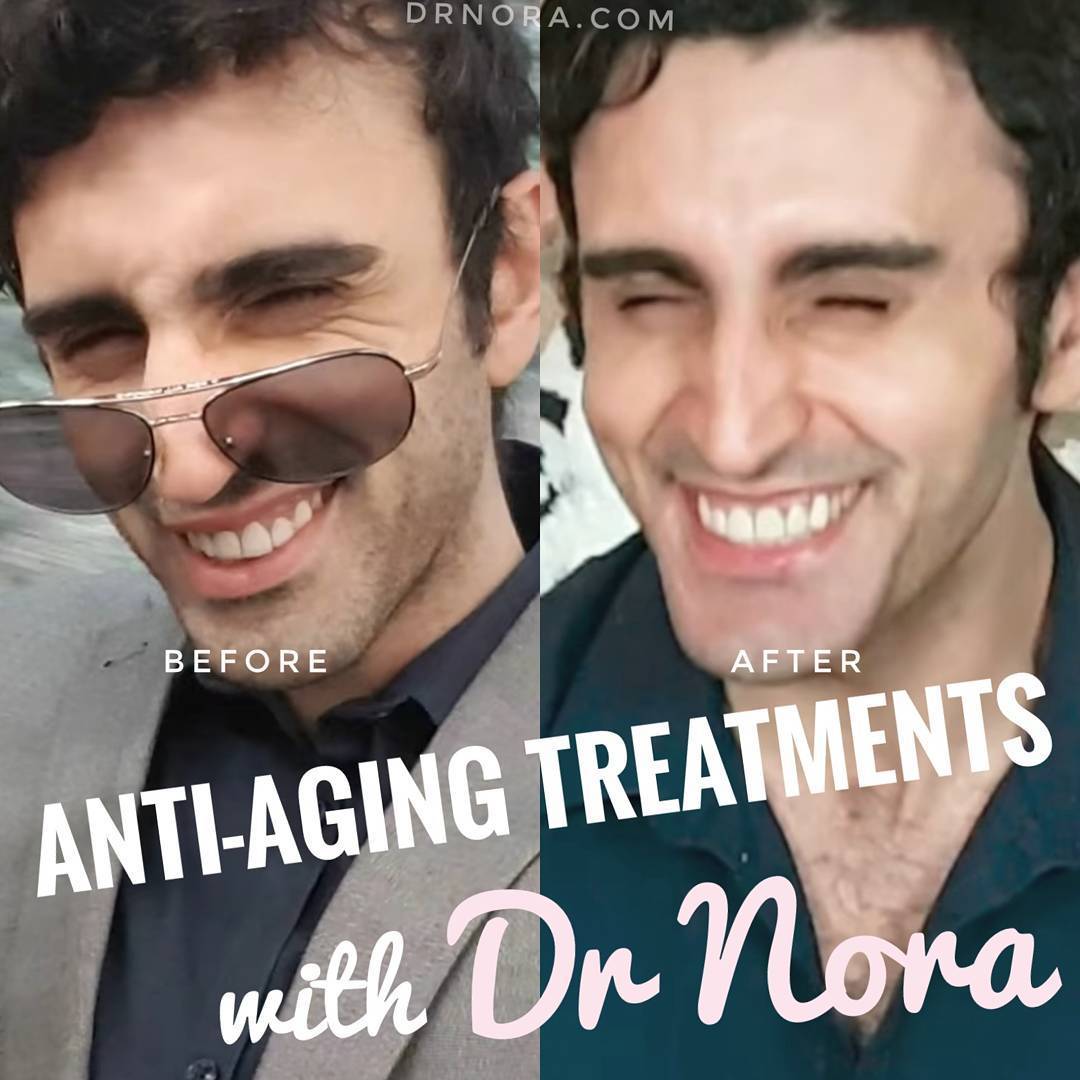 π Fantastic anti-wrinkle injection result to treat this patient’s crowsfeet (eye wrinkles). If you have any questions leave a comment below or drop by my website: drnora.comSource: https://instagram.com/p/BY-LRpRjOkL/