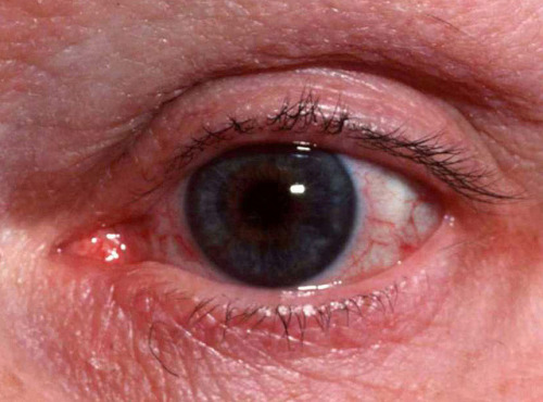 fohk:  Types of Rosacea: Eye Irritation by RosaceaFacts.com on Flickr.