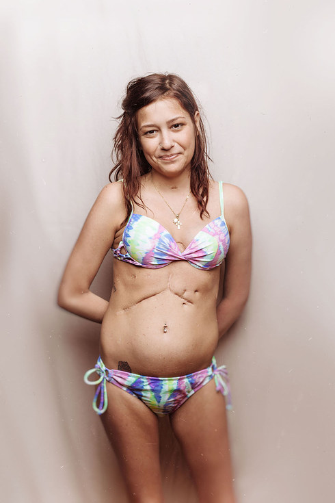 talapishka:    A Photographer Started A Photo Project To Show That Women With Cystic