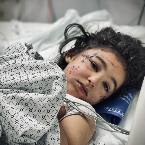 The Little Girl Aseel Musameh, 7 Years Old, Was Injured Following The Bombing Of Her House By Israel.