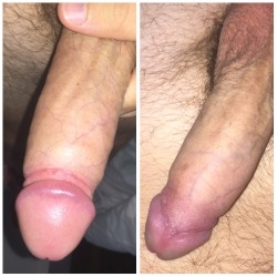 cutthecock:  Day 16 post op  A low circumcision so fresh the head still needs to dry out!