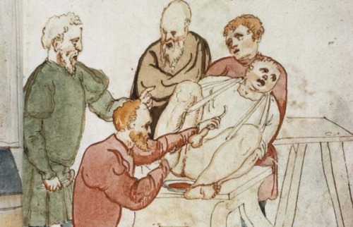 How to Remove a Kidney Stone in the Middle Ages,During the Middle Ages up to around 19th century, ad