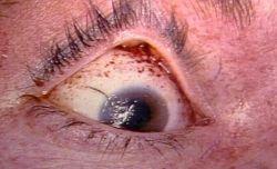 bundyspree:  Petechiae located under eyelid after strangulation