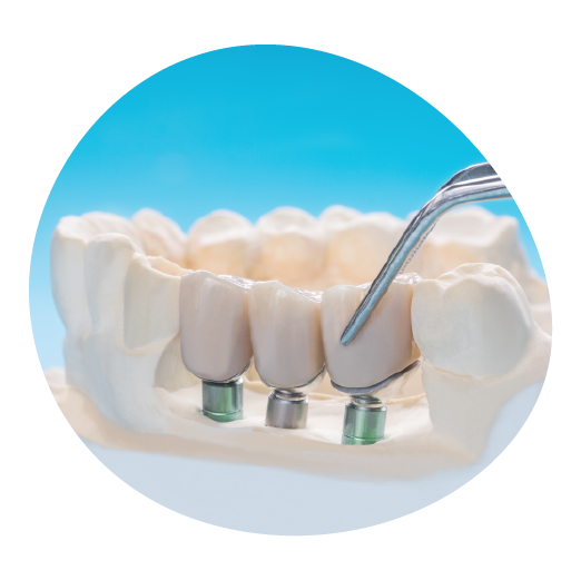 Untitled — Cost of dental implants in Bangalore|Dental...