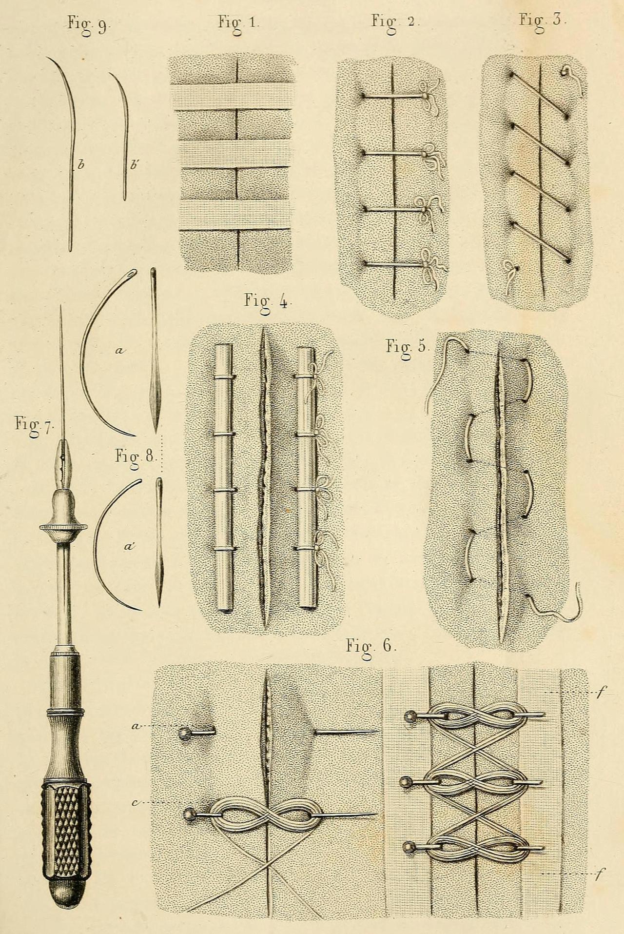 Wound Closure Techniques