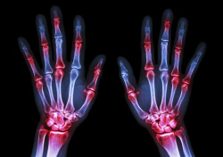 medresearch:  Finding new path to treating rheumatoid arthritis A small molecule blocked a cellular channel called KCa1.1, which is known to exist at high levels in rheumatoid arthritis, and reduced the negative effects of the disorder, said a consortium