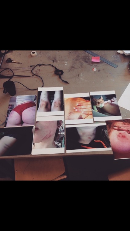 thebruisesofeverydaylife:  A little collection of some of my bruises /Felicia.My