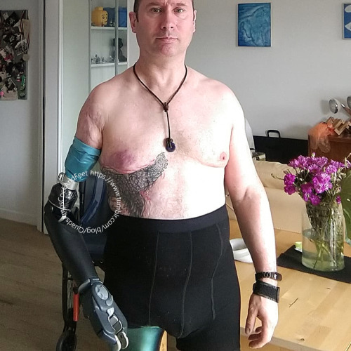 This guy endured some horrific burns from a motorcycle accident, which resulted in losing 3 limbs.  