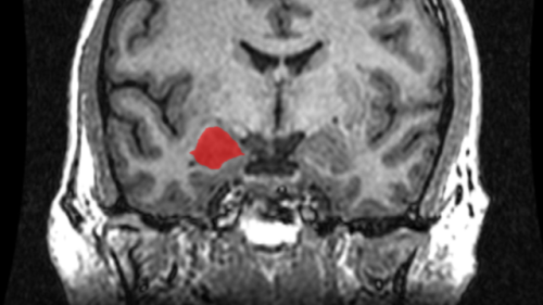 neurosciencestuff:(Image caption: MRI Coronal View of the Amygdala. Credit: Amber Rieder, Jenna Tray