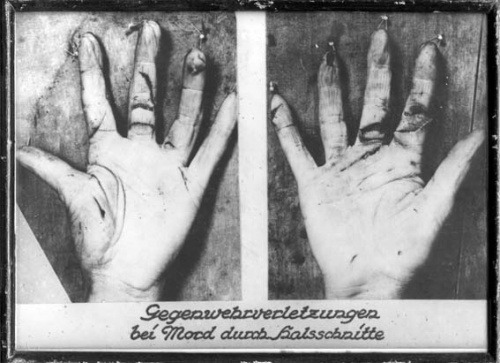 XXX Defense wounds to hand from antique forensic photo