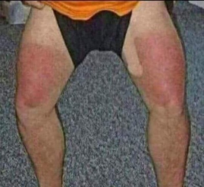 That one time I got sun  poisoning !! ￼