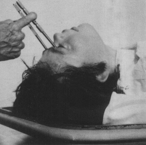 Frontal Lobotomy: It involved…Brain slicing! Essentially, it involved the insertion