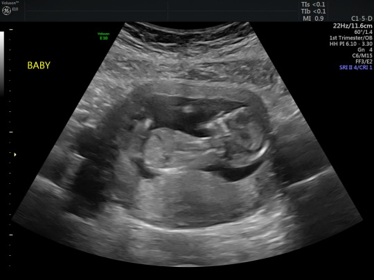 👍 ultrasound guidelines for pregnancy