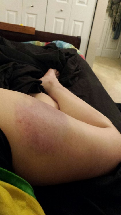 Went to a party with Reaction Junkie last night. First big ass bruise in far too long! More pictures