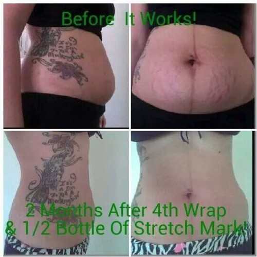 Lose weight AND get rid of stretch marks #losebabyweight #lovemykidnotthestretchmarks #makeachange
