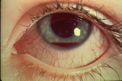 congenitaldisease:  Hyphema is the term for a collection of blood inside the front part of the eye. Blood may cover part, or all, of the iris and can block vision.