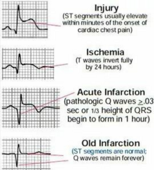 studentparamedicsaus: Just some of the possible ECG changes in cardiac injury. 