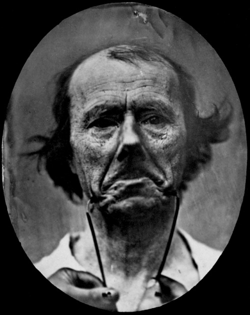 Guillaume-Benjamin Duchenne. Figure 44. The Muscle Of Sadness (detail). 1854-1856