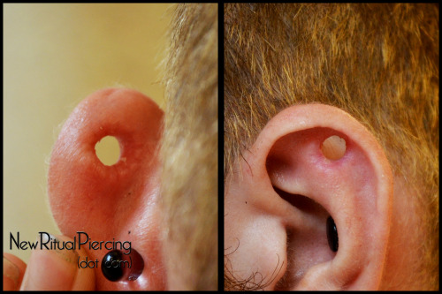 newritual: Cartilage removal (~9mm), fresh and healed (at 4 weeks), by Victor VanOrden 