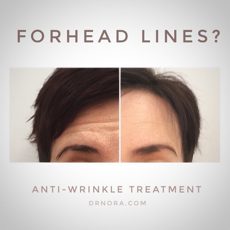 I just love the outcome of anti-wrinkle treatment, so satisfying! 👌
This patient previously had a bad experience elsewhere with anti-wrinkle treatment to her forehead. She had developed forehead heaviness which can happen if too much product is used...