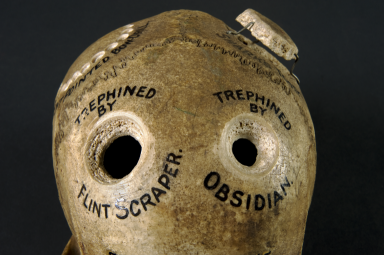 L0058797 Human skull illustrating different methods of trephination Credit: Science Museum London  http://www.flickr.com/photos/wellcomeimages/6880272704/in/set-72157629694243291