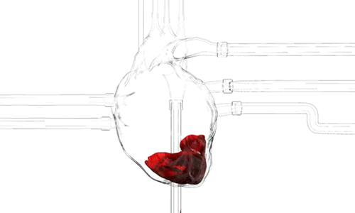 Systolic v Diastolic Heart Failure