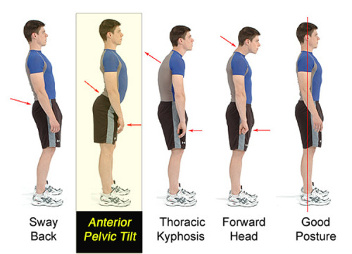 the-exercist:
“Let’s take a minute to talk about the anterior pelvic tilt, shall we?
An Anterior Pelvic Tilt is a posture problem that naturally occurs in many people when they sit for hours each day. It’s caused by a “shortening” and stiffening of...