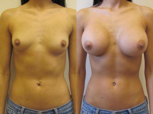 addicted2implants:  i would have let her get bigger ones if she wanted to.  looking great!  nice upgrade.