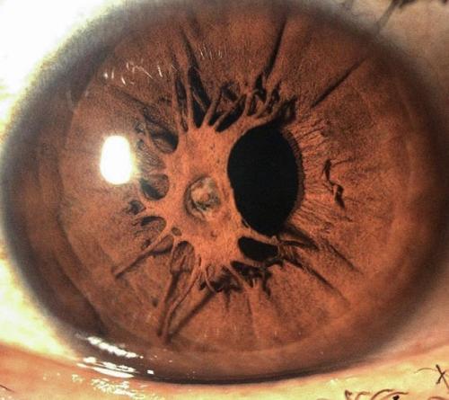 psychopathicneighbor:  A mutated iris slowly growing over the pupil.