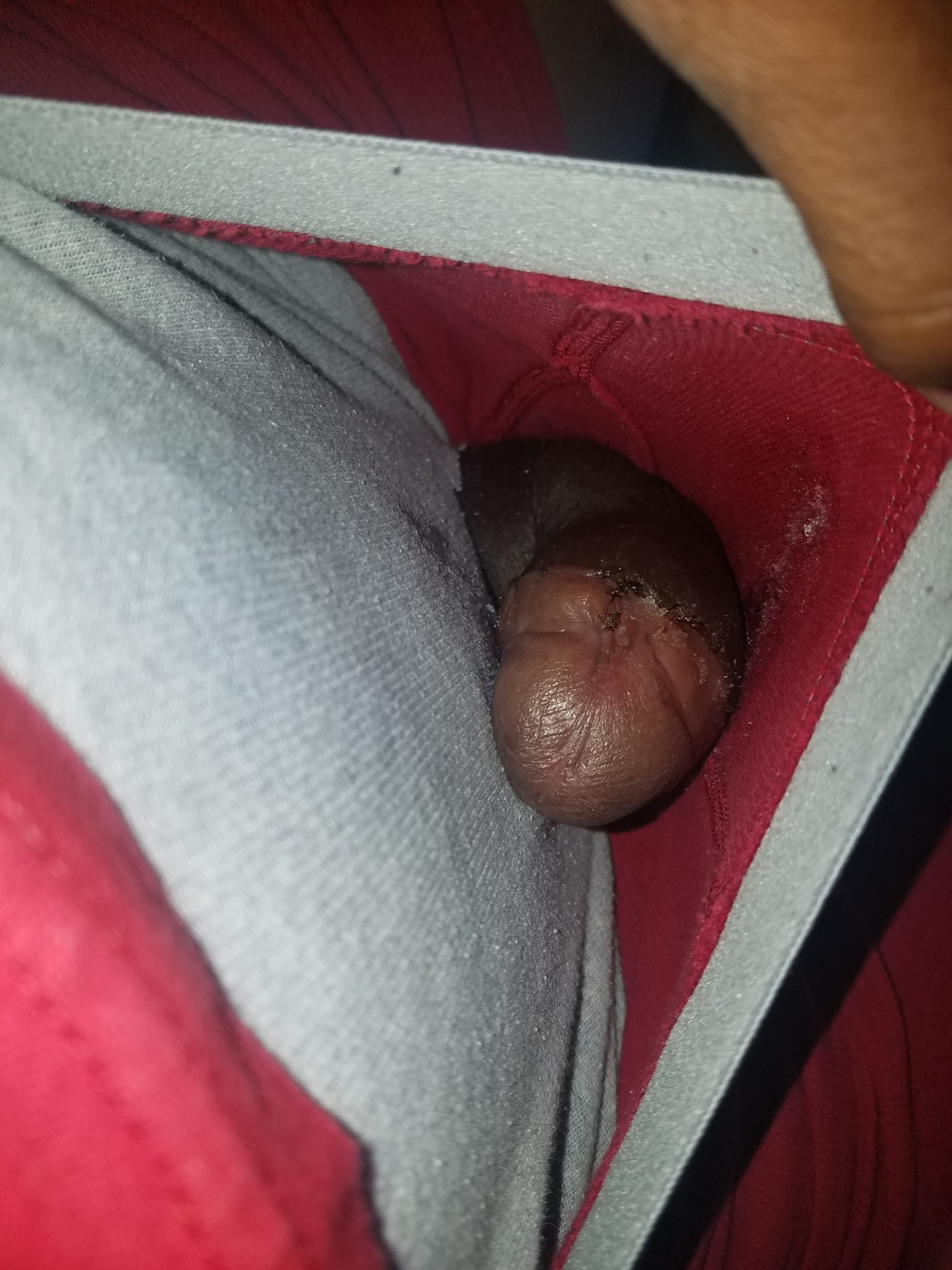 justmystory92:  DAY 5 Nothing really new to report. Minor pain a suture got stuck