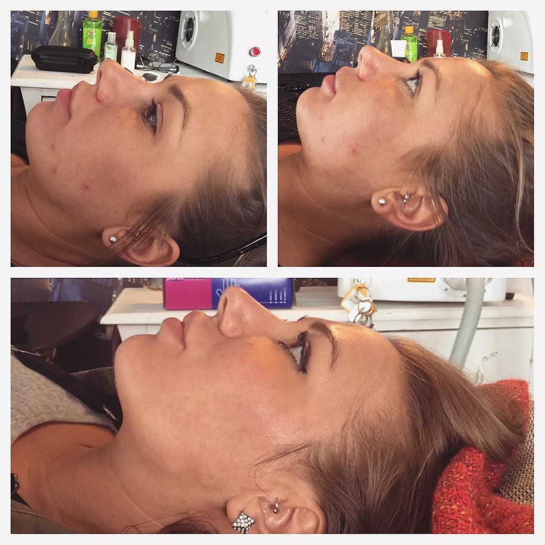 Top left before 1st carbon facial! Top right after 1st facial! Bottom after 2nd facial