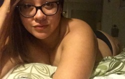 “I Haven’t Felt Comfortable In My Own Skin Since My Amputation But I’ve Never