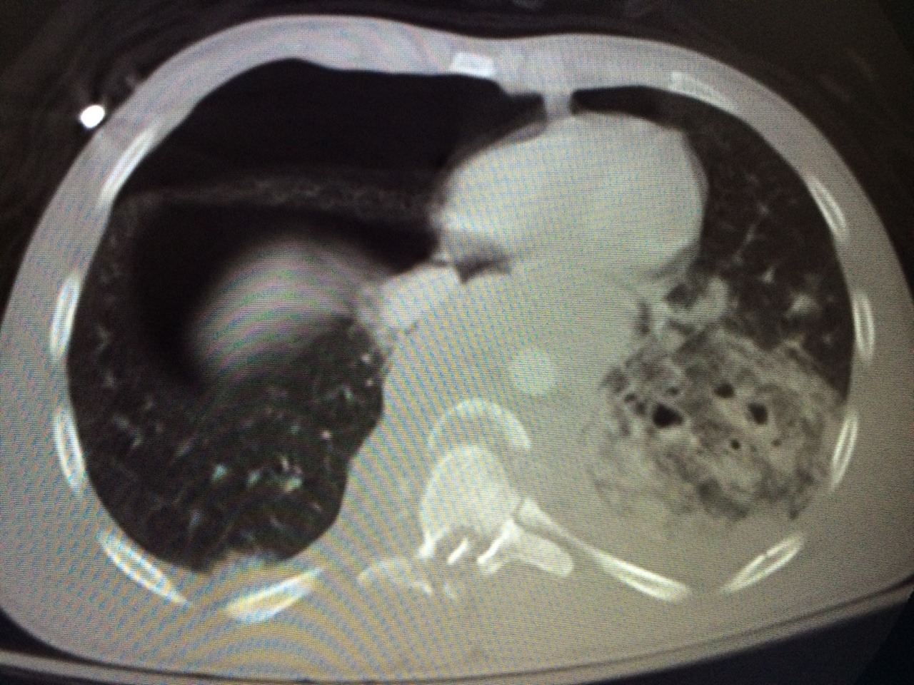 nurseeyeroll:  myradfindings:  easily the worst thoracic spine fracture I have ever