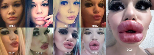 wannabebubblebuttslut2: plastic-lover:Let’s hope for a year full of fillers for the most amazi