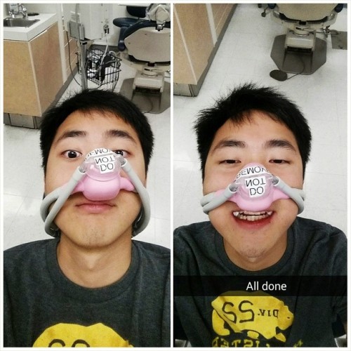 Before and after #selfie getting my wisdom teeth pulled #gassed (at UCLA School of Dentistry)