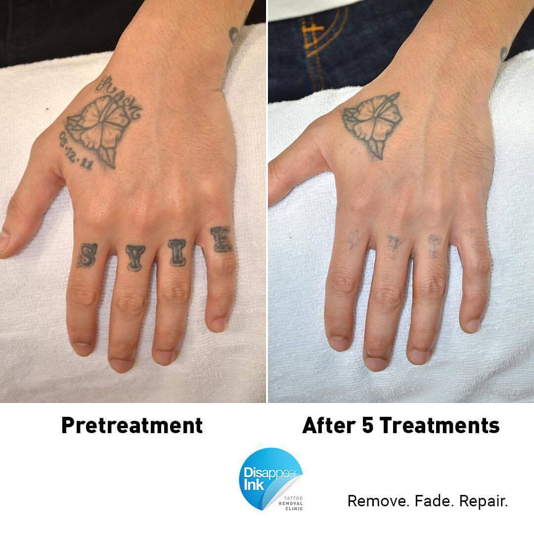 Laser Tattoo Removal  Lincoln Laser Skin Care