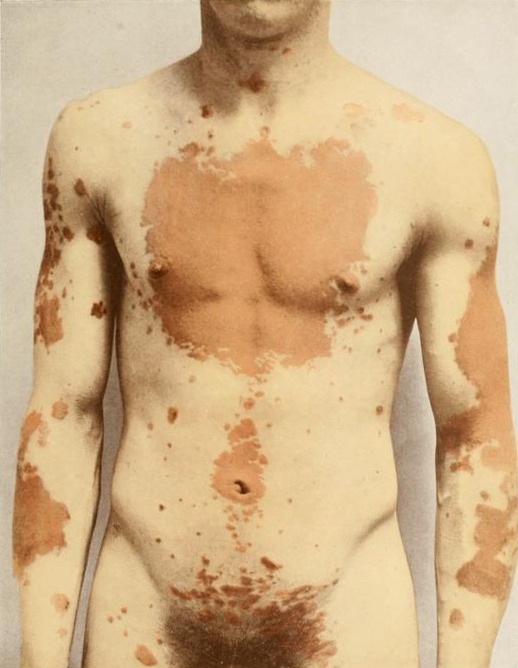 ourskin:  nuclearharvest: From the book ”Photographic atlas of the diseases of